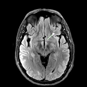 MRI scan of the brain with an arrow indicating a highlighted area near the center of the image.